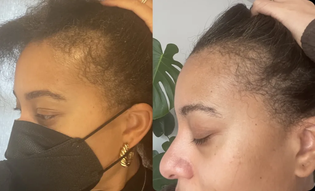 Two photos side by side. In each photo, the woman is holding her hair up to reveal her thinning hairline.